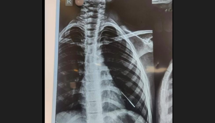AIIMS-Bhubaneswar”s Doctors Successfully Remove Stitching Needle From Minor Boy’s Lungs
